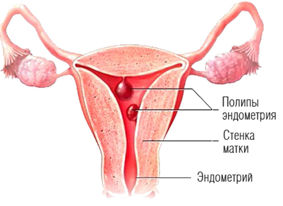 иллюстрация полипы эндометрия в полости матки