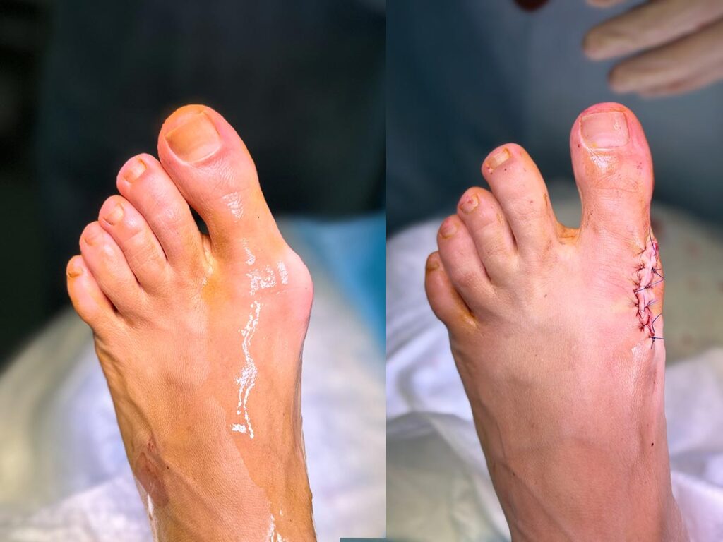 Исправление выпирающая косточка большого пальца на ноге. Результат до и после операции.